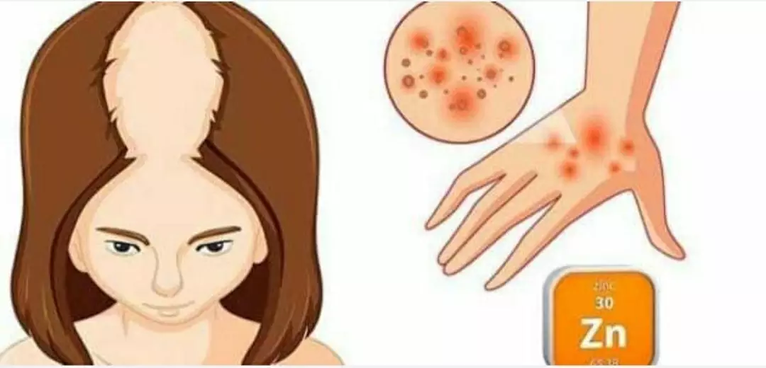 علامات نقص الزنك 